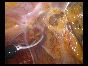 ADHESIONS BOWELS OMENTAL6 ADHESIONS BOWELS OMENTAL6
